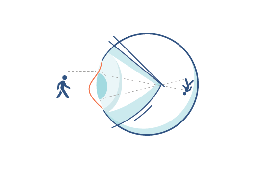 Illustration d’un œil d’une personne astigmate.
