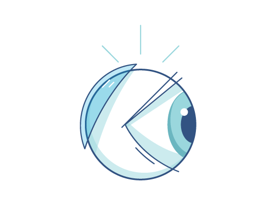 Illustration d'une lentille de contact derrière un globe oculaire.
